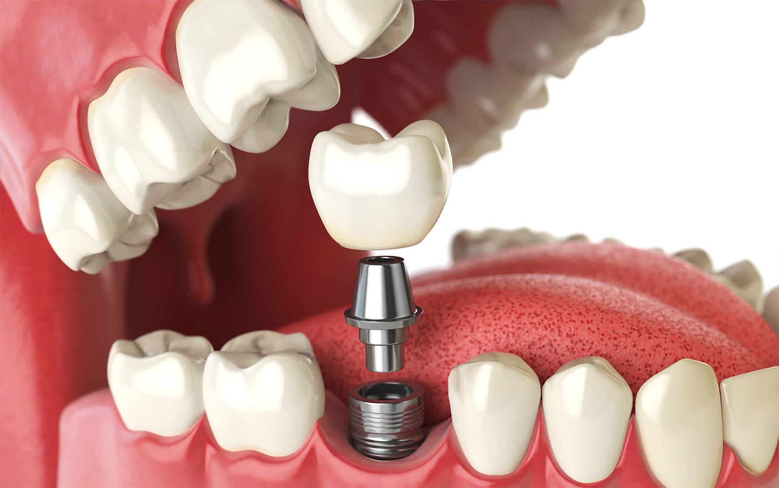 Navigating the Future: Personalised Pathways in Dental Implant Success